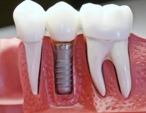 Установка качественных имплантанов зубов