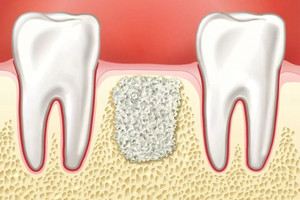 Имплантация зубов в Риге: честный обзор, преимущества, сроки